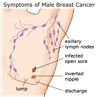 Και οι άνδρες κινδυνεύουν από τον καρκίνο του μαστού