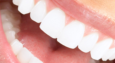 Όσα πρέπει να ξέρετε για τη λεύκανση δοντιών