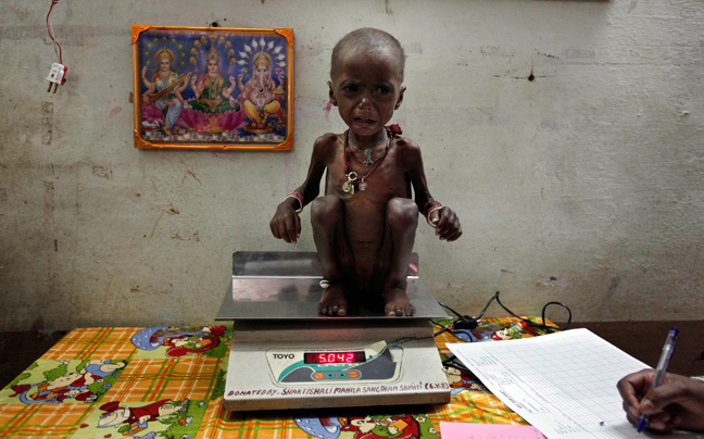 INDIA MALNUTRITION4 ΣΥΓΚΛΟΝΙΣΤΙΚΕΣ ΦΩΤΟΓΡΑΦΙΕΣ: Παιδιά ενός κατώτερου θεού...