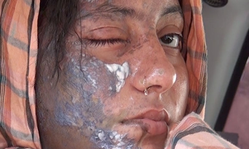 Επίθεση με οξύ σε Πακιστανή ηθοποιό