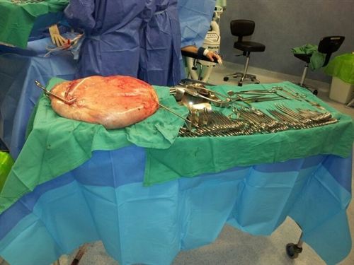 Χειρουργοί αφαίρεσαν όγκο 25 κιλών από γυναίκα