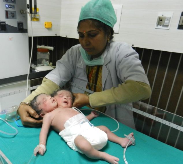 Μωρό με δύο κεφάλια γεννήθηκε στην Ινδία