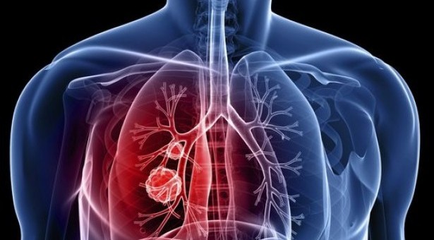 Ο καρκίνος του πνεύμονα «κρύβεται» για χρόνια