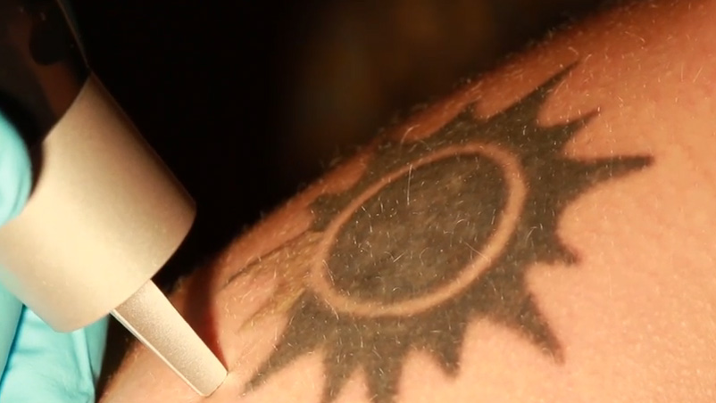 Πώς γίνεται η αφαίρεση τατουάζ με λέιζερ