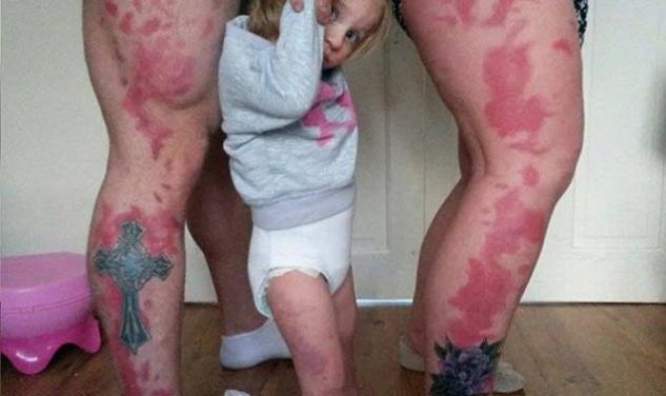 Έκαναν τατουάζ τα εκ γενετής σημάδια της κόρης τους