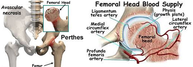 Τι είναι η νόσος Perthes   Υγεία