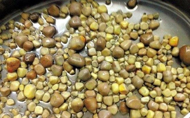 Γιατροί αφαίρεσαν 420 πέτρες από τα νεφρά ασθενή   Υγεία