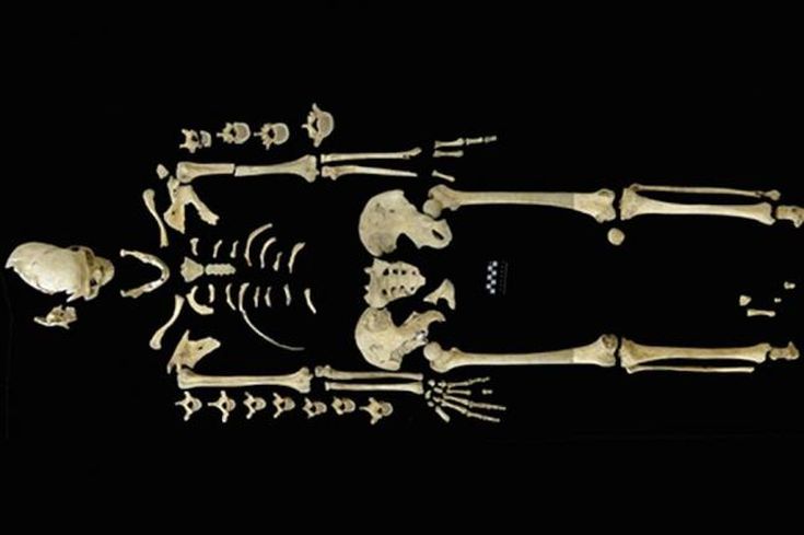 Ανακαλύφθηκε πιθανώς η αρχαιότερη περίπτωση λευχαιμίας