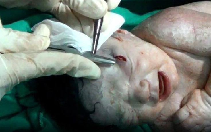 Αγέννητο μωρό στη Συρία τραυματίστηκε από θραύσμα στο κεφάλι!