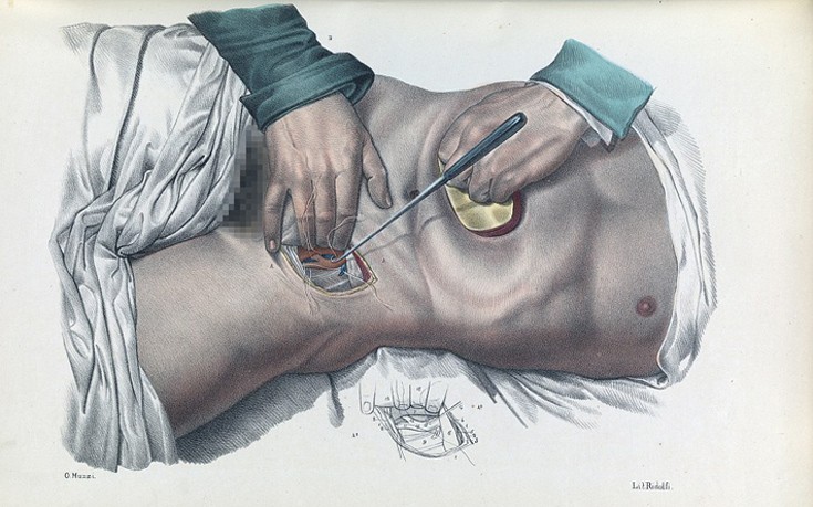 Πώς γίνονταν οι χειρουργικές επεμβάσεις το 1840
