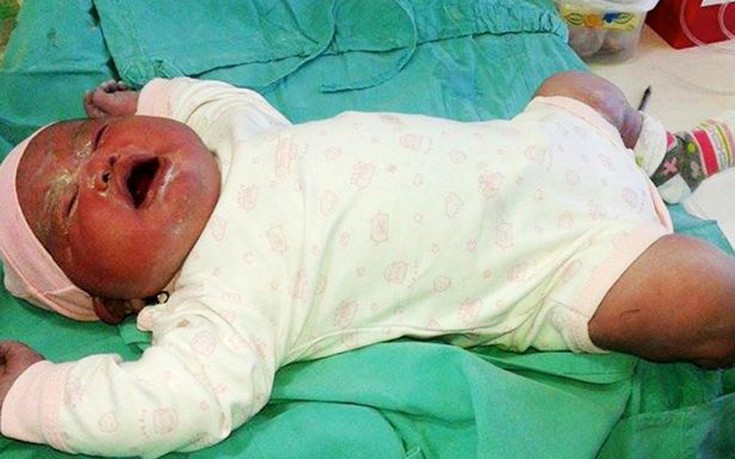 Το «σούπερ-μωρό» που γεννήθηκε με βάρος πάνω 6 κιλά