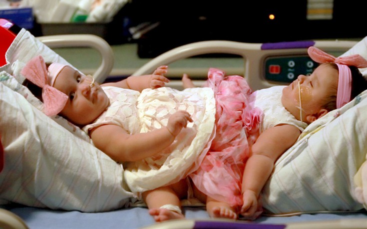 Διαχωρίστηκαν σιαμαία κοριτσάκια που γεννήθηκαν από τρίδυμη κύηση