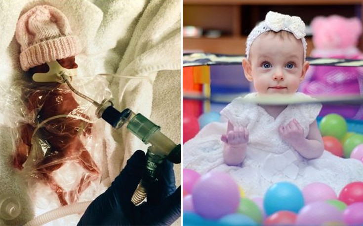 Η μικροσκοπική αγωνίστρια που γεννήθηκε μισό κιλό και χθες έσβησε το πρώτο της κεράκι