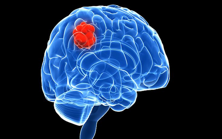 Πώς συνδέεται ο καρκίνος του εγκεφάλου με την υψηλή μόρφωση