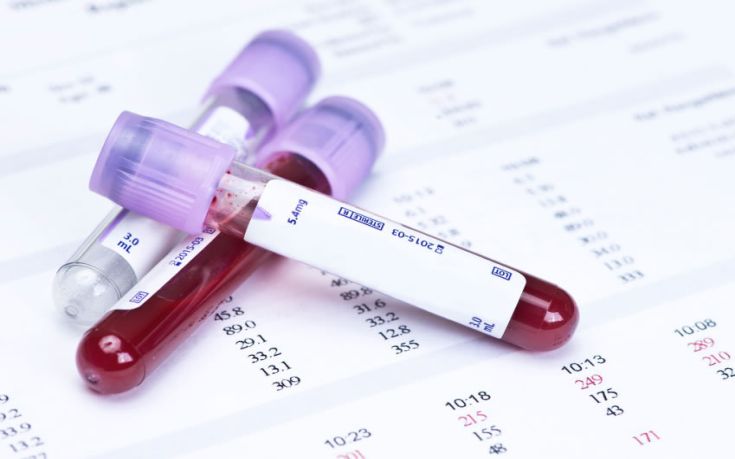 Τεστ αίματος για τη διάγνωση της οστεοαρθρίτιδας