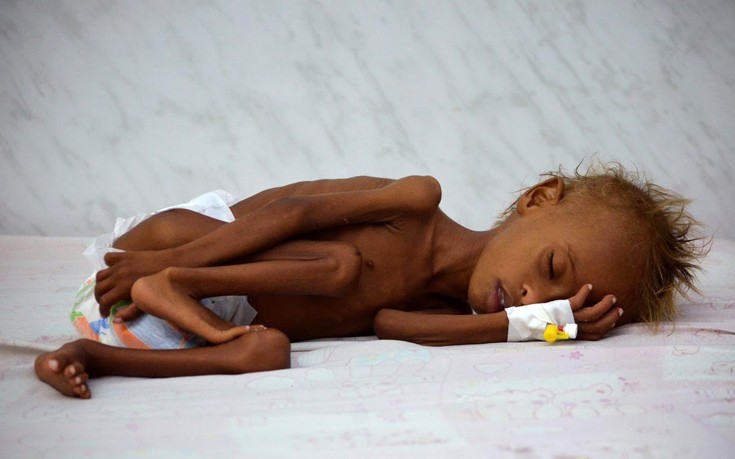 Η πείνα απειλεί τα παιδιά της Υεμένης