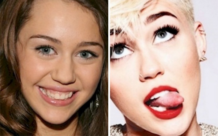 Διάσημοι πριν και μετά την πλαστική στη μύτη
