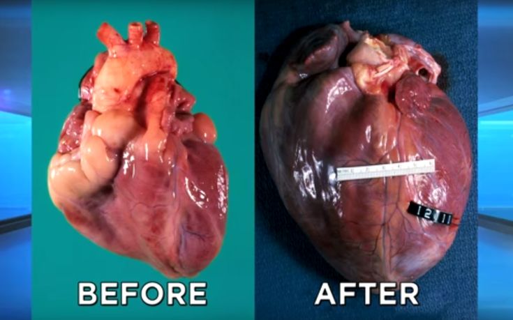 Πώς γίνεται η καρδιά μετά από μακροχρόνια χρήση κοκαΐνης