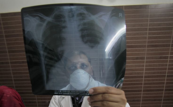 Πονοκέφαλος η πολυανθεκτική φυματίωση, τι γίνεται στην Ελλάδα