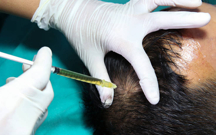 Άνδρας πέθανε μετά από… υπερβολική μεταμόσχευση μαλλιών