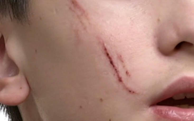 Νέα επίθεση στην Καλλιθέα: Μαθητής «χαράκωσε» με κλειδί στο πρόσωπο 14χρονο συμμαθητή του