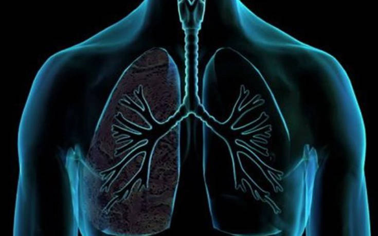 Περισσότερες από 7.000 νέες περιπτώσεις καρκίνου του πνεύμονα κάθε χρόνο στην Ελλάδα