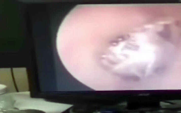 Ανατριχιαστικό βίντεο με αράχνη που είχε υφάνει ιστό στο αυτί μιας γυναίκας