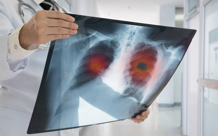 Αυξημένος ο κίνδυνος καρκίνου των πνευμόνων για ασθενείς με ΧΑΠ που δεν κάπνισαν ποτέ