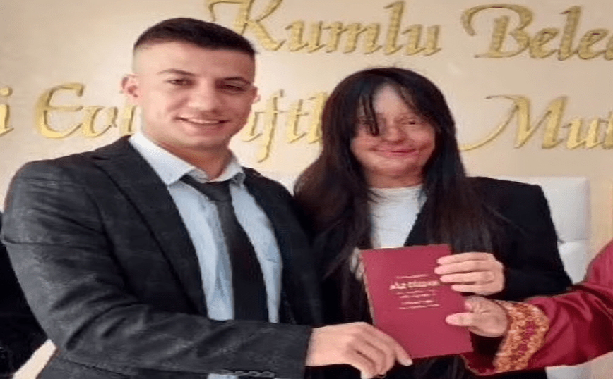 Σάλος στην Τουρκία: Γυναίκα παντρεύτηκε τον άνδρα που της έριξε οξύ στο πρόσωπο