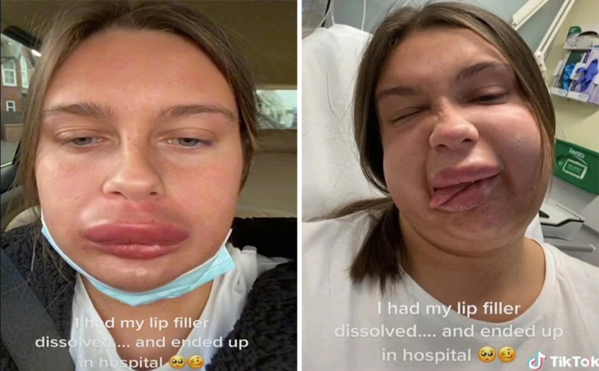 «Μου φωνάζουν Hommer Simpson»: Το πρόσωπο γυναίκας παραμορφώθηκε μετά από αλλεργική αντίδραση σε πλαστική επέμβαση