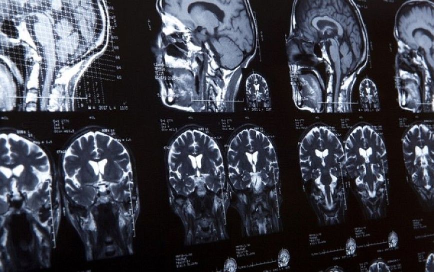 Νέος τρόπος διάγνωσης εγκεφαλικών όγκων &#8211; Πως θα γίνεται η εξέταση