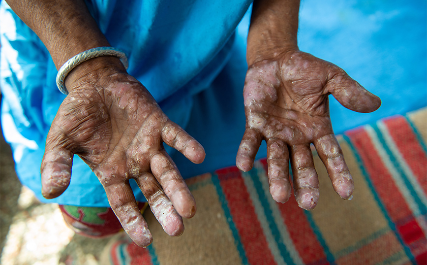 Λέπρα: Τι είναι η νόσος του Χάνσεν που ανοίγει πληγές και μπορεί να προκαλέσει απώλεια δακτύλων σε χέρια και πόδια