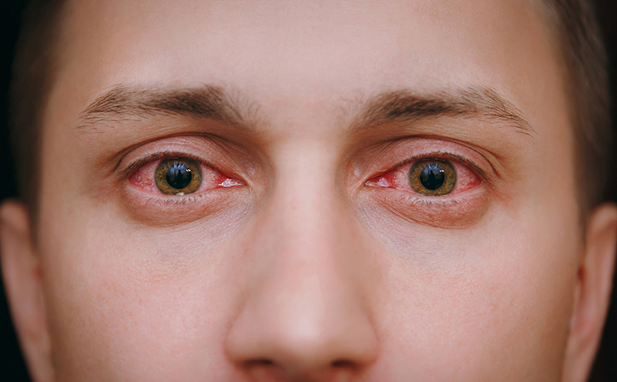 Πώς τα κόκκινα μάτια μπορεί να είναι σημάδι μιας θανατηφόρας βικτωριανής ασθένειας