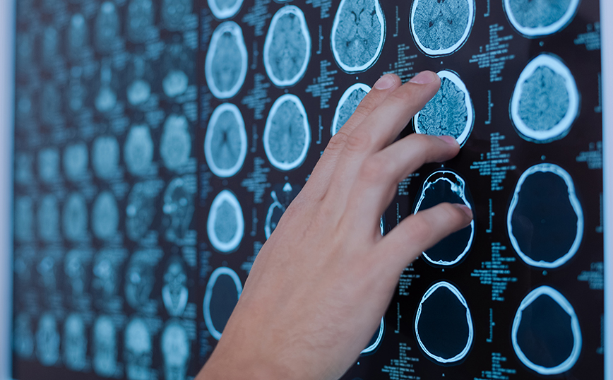 Πρωτοποριακή θεραπεία στοχεύει τον όγκο στον εγκέφαλο πριν την εγχείρηση