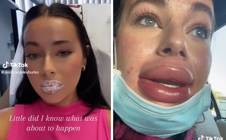 Γυναίκα έγινε viral μετά το ραντεβού της για δωρεάν υαλουρονικό στο χείλη &#8211; «Πήγα να τα φτιάξω και κάτι κακό συνέβη»