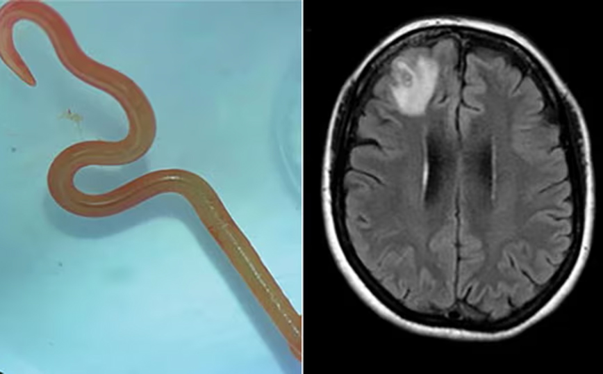 «Ω Θεέ μου!» &#8211; Για πρώτη φορά βρέθηκε στον εγκέφαλο ασθενούς παρασιτικό σκουλήκι 8 εκατοστών