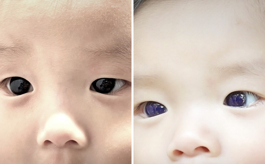 Τα καφέ μάτια βρέφους έγιναν γαλάζια μετά από φάρμακο για τον κορονοϊό – Προβληματισμένοι οι ειδικοί