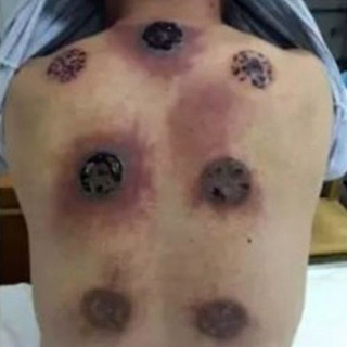 cupping-therapy-1