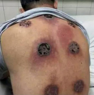 cupping-therapy-2
