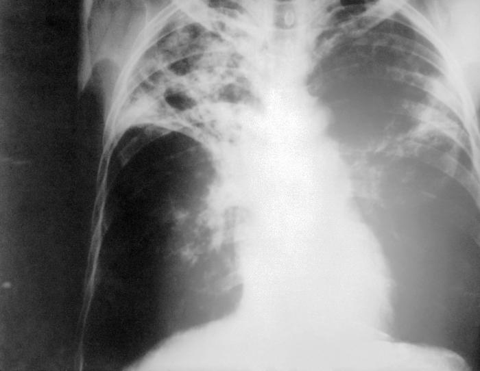 Νέο τεστ για στέλεχος της φυματίωσης