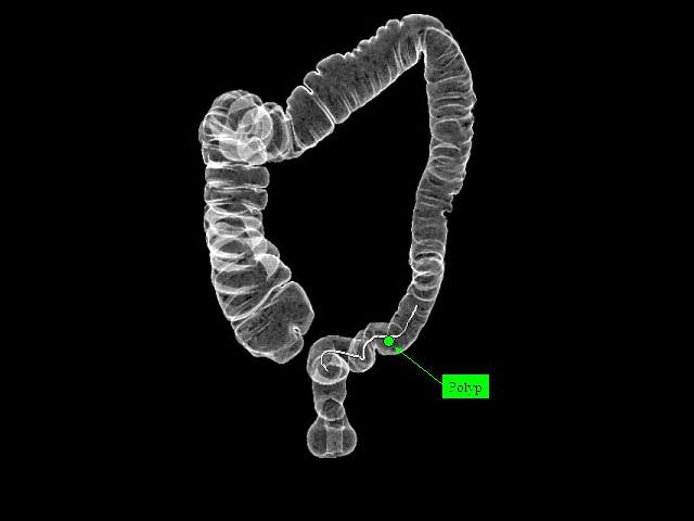 Η κολονοσκόπηση «χάνει» το 8% των καρκίνων στο έντερο