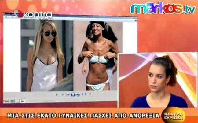 Νευρική ανορεξία, μόδα ή σύγχρονη μάστιγα