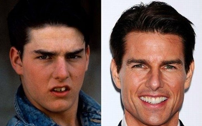 Οι διάσημοι πριν και μετά την επίσκεψη στον οδοντίατρο!