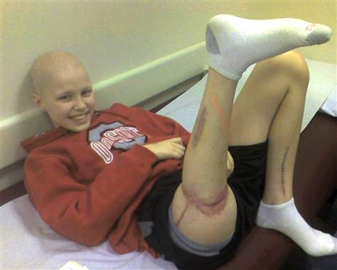 «Κόλλησαν» το πόδι του ανάποδα για να τον σώσουν από τον καρκίνο