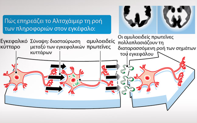 Τι συμβαίνει στον εγκέφαλο πασχόντων από Alzheimer