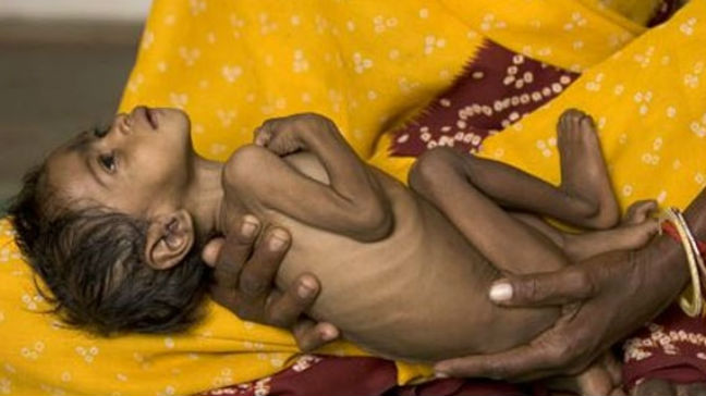 Πάνω από 2.500 παιδιά πέθαναν από υποσιτισμό τους πρώτους οκτώ μήνες