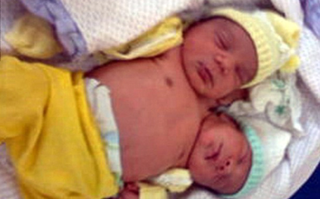 Μωρό με δύο κεφάλια γεννήθηκε στη Βραζιλία