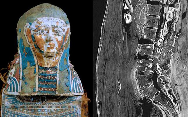 Βρέθηκε μούμια 2.200 ετών με καρκίνο του προστάτη
