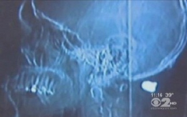 Σφαίρα τον βρήκε στο λαιμό και… δεν τον σκότωσε!