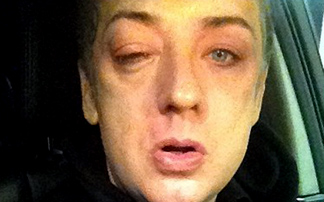 Γυναίκα μαύρισε το μάτι του Boy George!